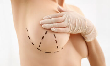 Everything You Need to Know About Breast Lift Surgery