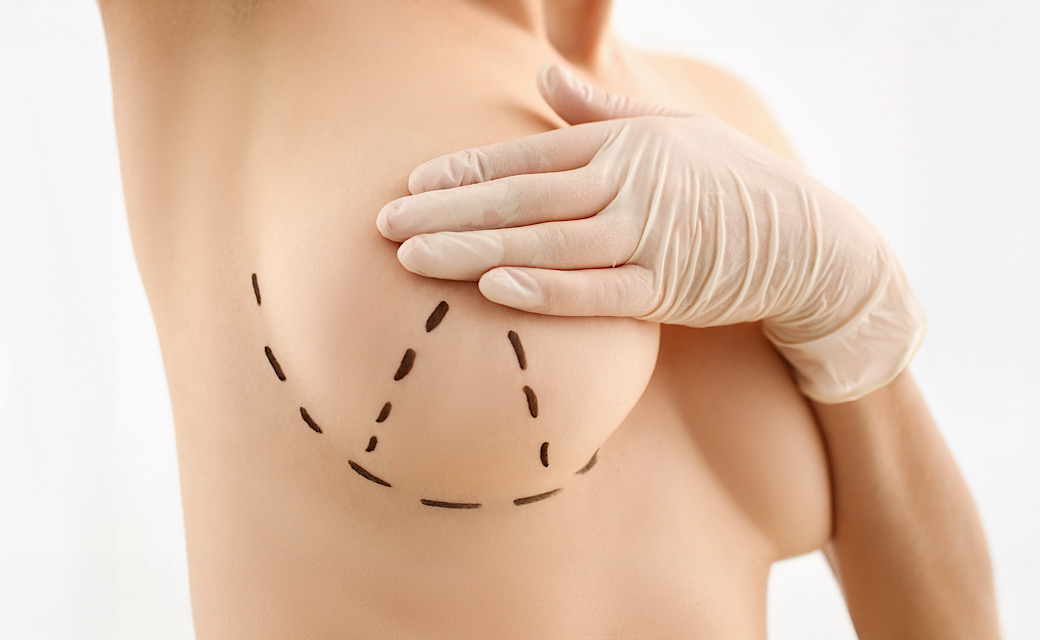 Breast lift, mastopexy, breast lift surgery Denver