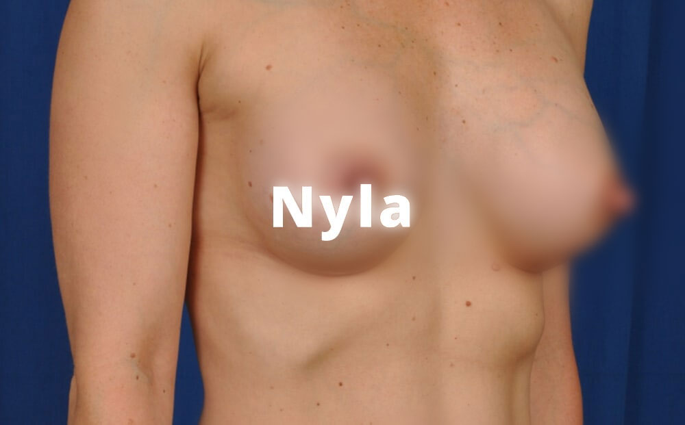 Nyla Teardrop implants