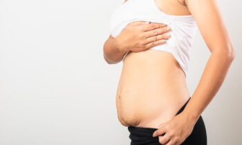 Mommy Makeover: The Complete Transformation for Your Post-Baby Body