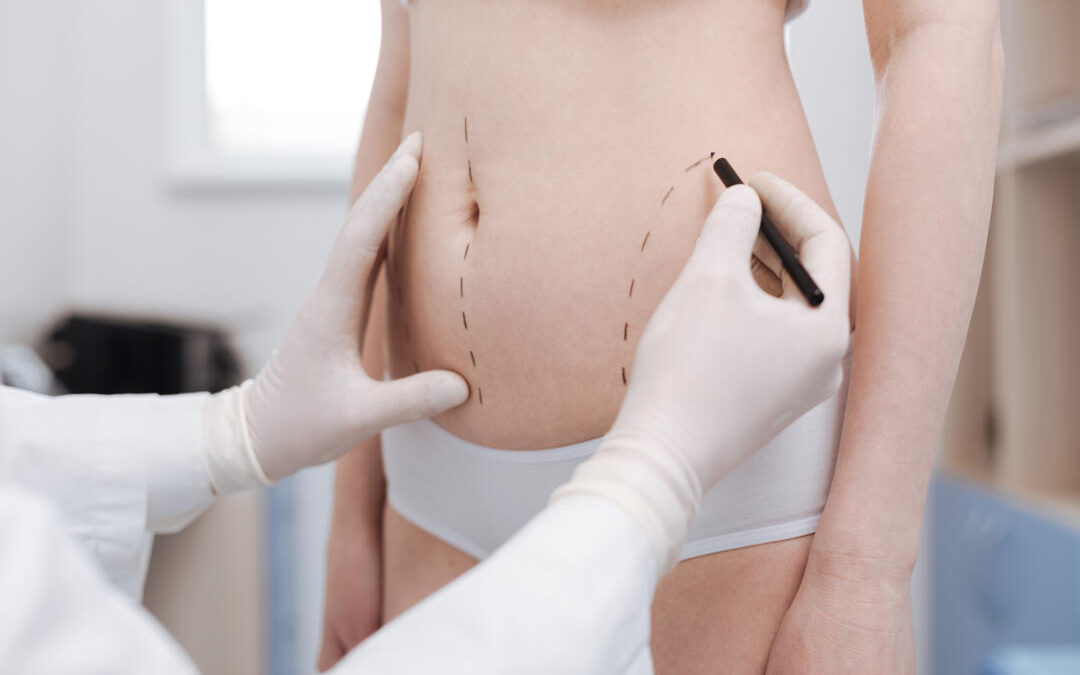 Sculpt Like a Pro: Liposuction Tips for Fitness Enthusiasts
